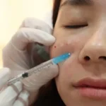 What is Rejuran treatment?